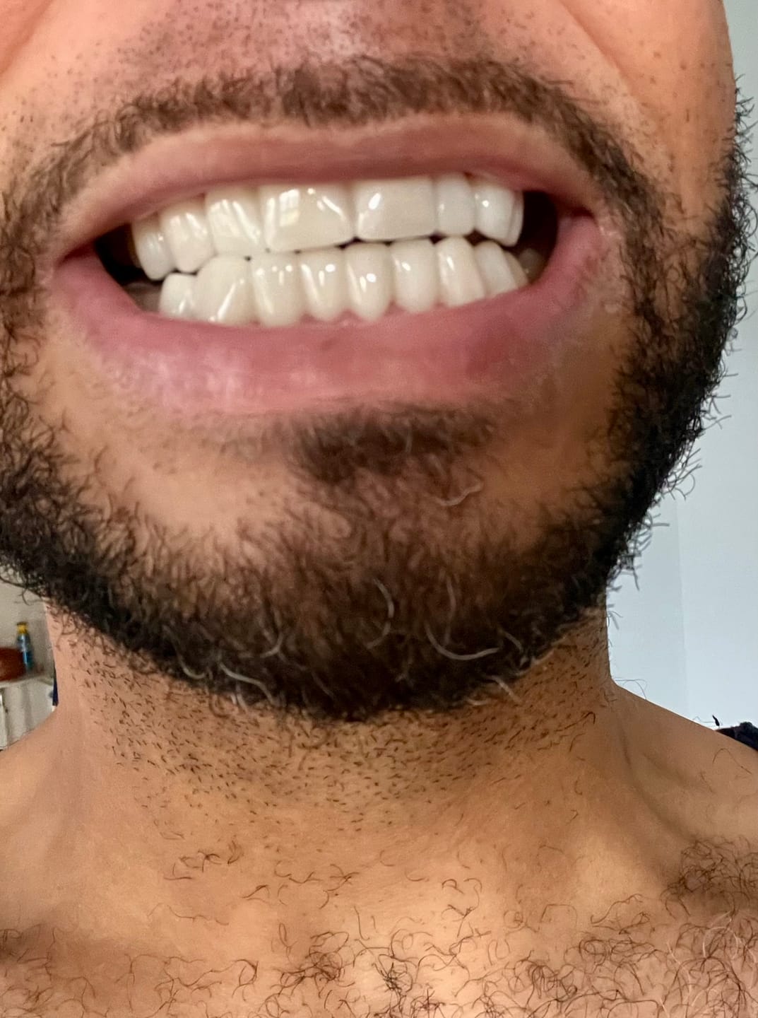 Snap On False Teeth Upper + Lower Dental Instant Veneers Dentures Tooth Cover White | Natural Look photo review