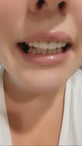Trevane Unisex Snap-On Veneers  | Natural Look | Instant Smile | BPA-Free| 1 pair (Uper and lower) photo review