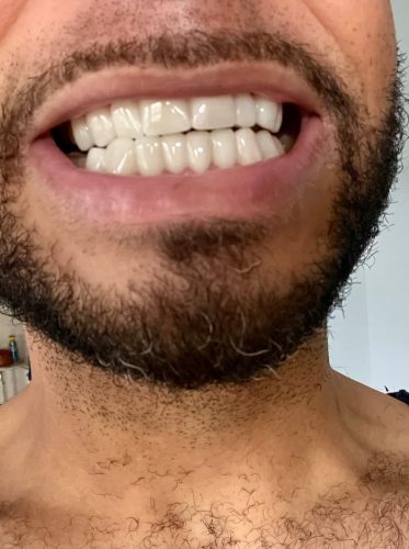 Trevane Unisex Snap-On Veneers  | Natural Look | Instant Smile | BPA-Free| 1 pair (Uper and lower) photo review