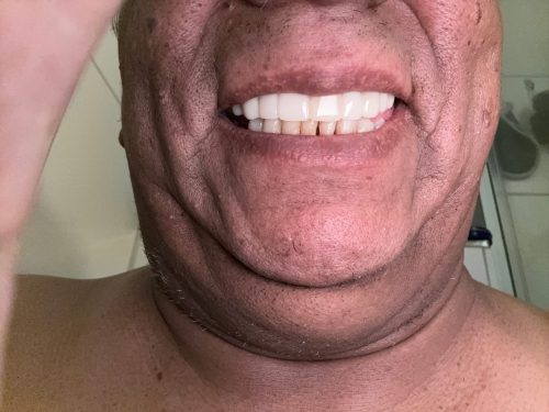 Trevane Unisex Snap-On Veneers  | Natural Look | Instant Smile | BPA-Free| 1 pair (Uper and lower) photo review