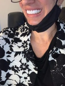 Trevane Unisex Snap-On Veneers  | Natural Look | Instant Smile | BPA-Free| 1 pair (Uper and lower) photo review