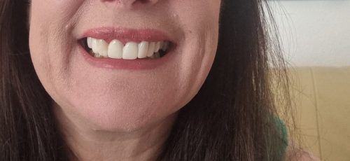 Trevane Unisex Snap-On Veneers  | Natural Look | Instant Smile | BPA-Free| 1 pair (Uper and lower) photo review